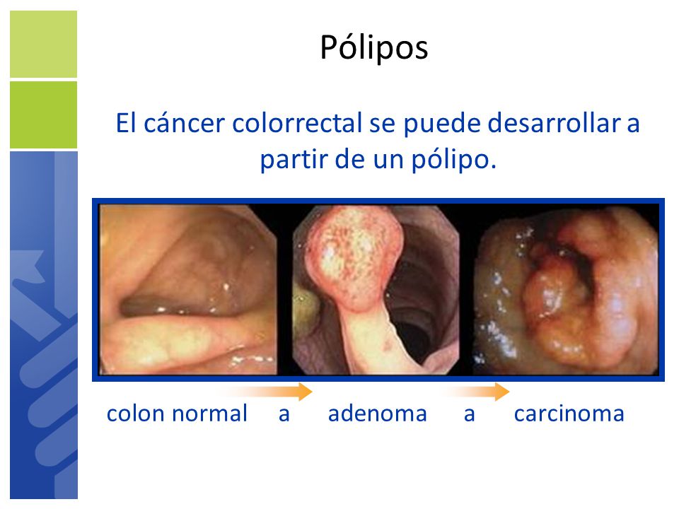 Pólipos El cáncer colorrectal se puede desarrollar a partir de un pólipo. colon normal a adenoma a carcinoma.