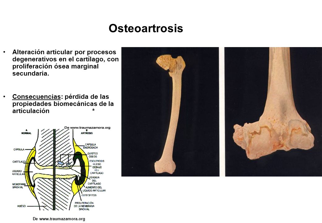 Osteoartrosis Alteración articular por procesos degenerativos en el cartílago, con proliferación ósea marginal secundaria.