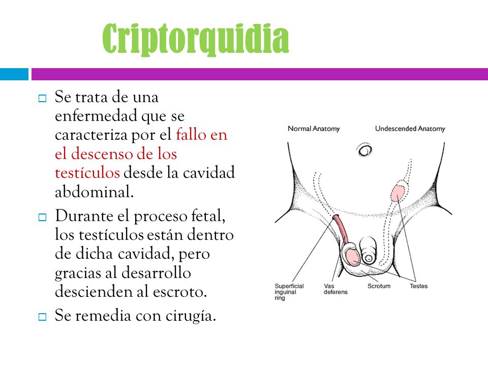 Criptorquidia Se trata de una enfermedad que se caracteriza por el fallo en el descenso de los testículos desde la cavidad abdominal.