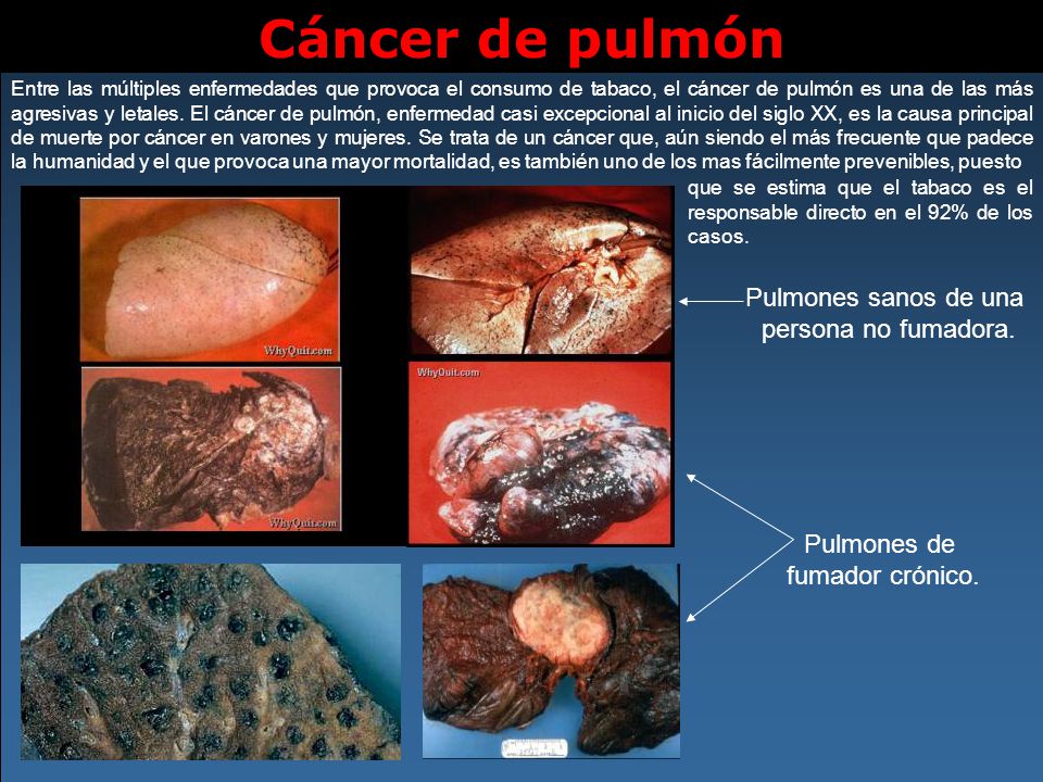 Cáncer de pulmón Pulmones sanos de una persona no fumadora.