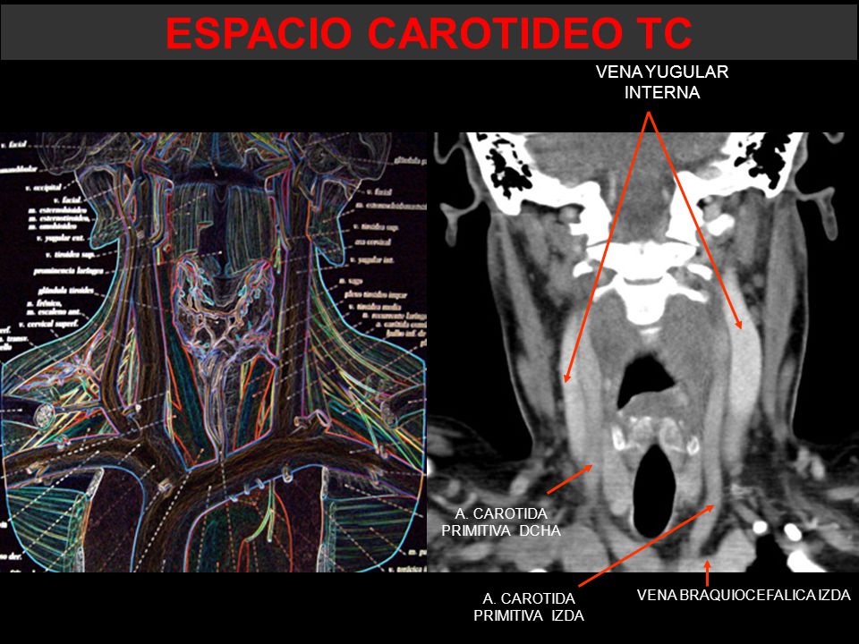 ESPACIO CAROTIDEO TC VENA YUGULAR INTERNA A. CAROTIDA PRIMITIVA DCHA