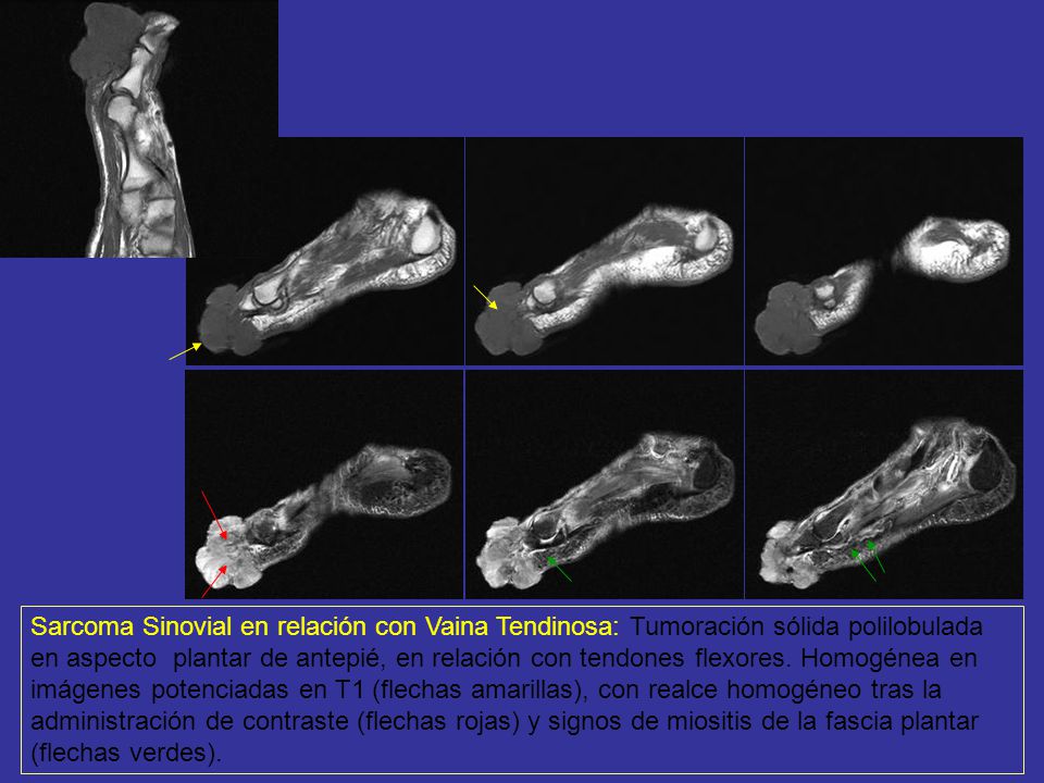 Sarcoma Sinovial en relación con Vaina Tendinosa: Tumoración sólida polilobulada en aspecto plantar de antepié, en relación con tendones flexores.