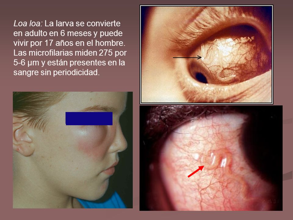 Loa loa: La larva se convierte en adulto en 6 meses y puede vivir por 17 años en el hombre.