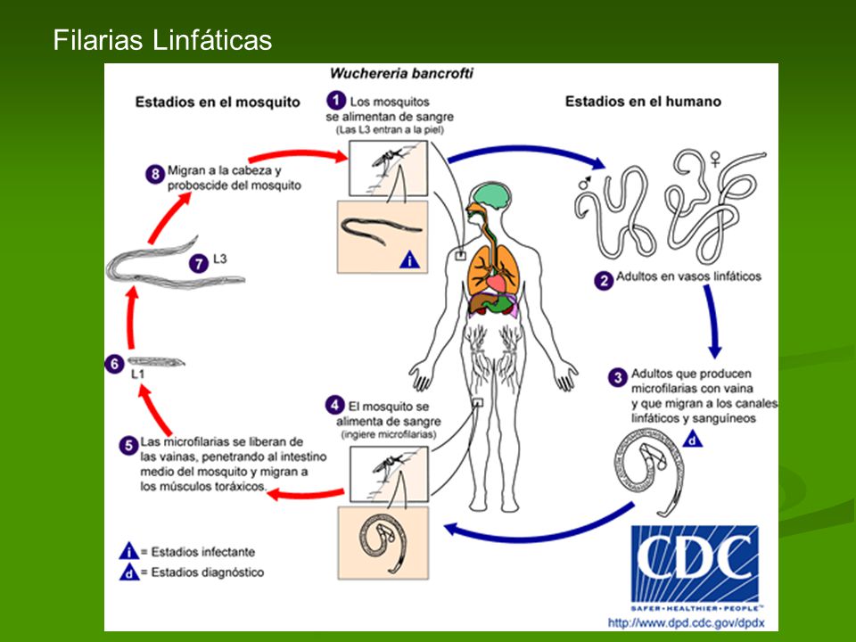 Filarias Linfáticas