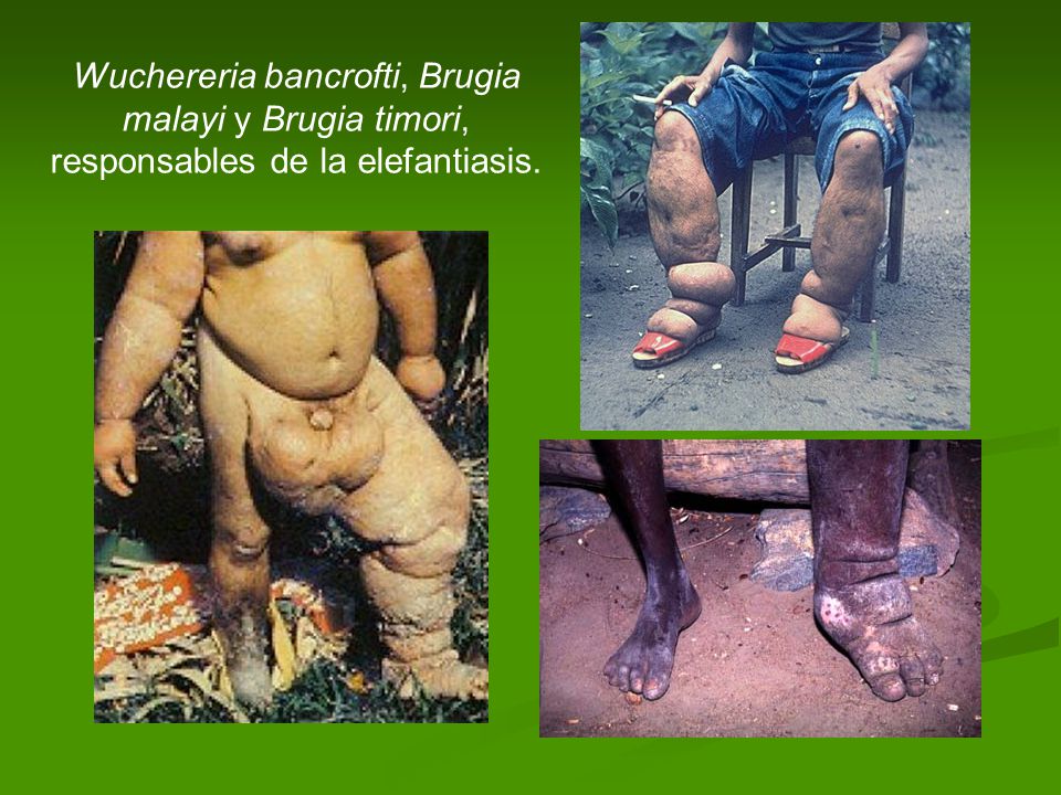 Wuchereria bancrofti, Brugia malayi y Brugia timori, responsables de la elefantiasis.