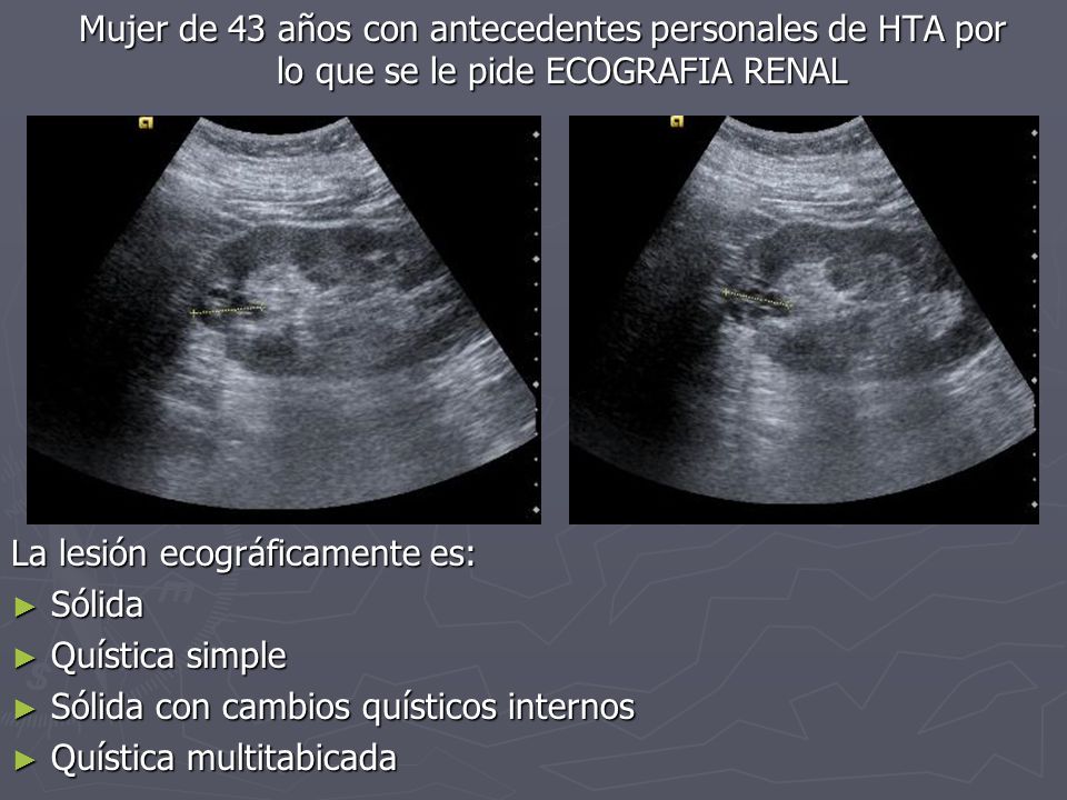 Mujer de 43 años con antecedentes personales de HTA por lo que se le pide ECOGRAFIA RENAL