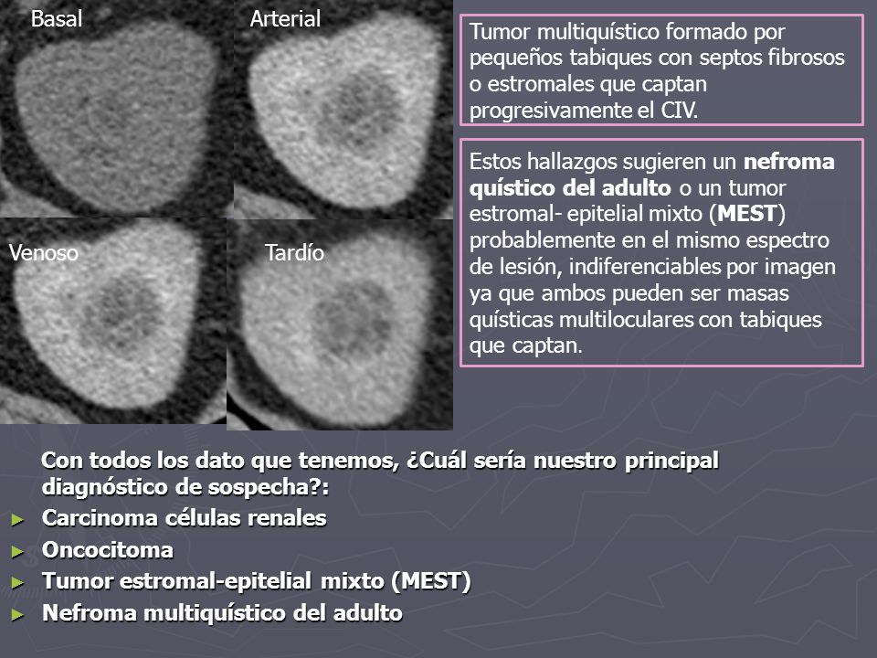Basal Arterial. Tumor multiquístico formado por pequeños tabiques con septos fibrosos o estromales que captan progresivamente el CIV.