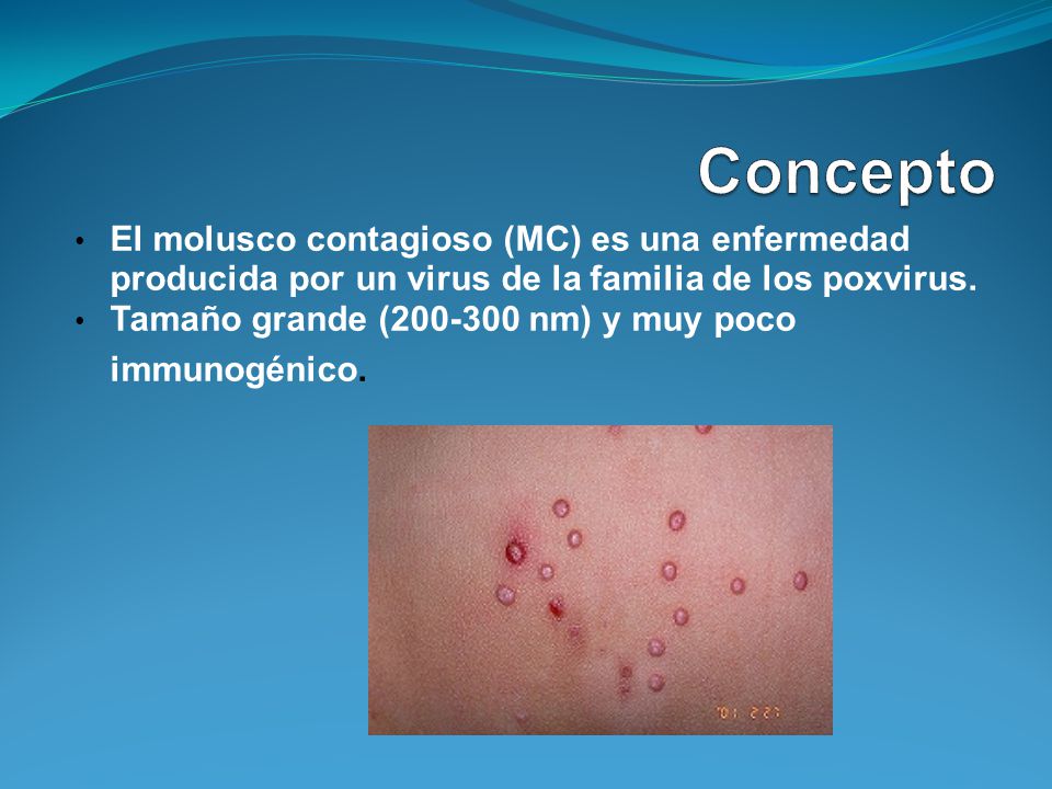 Concepto El molusco contagioso (MC) es una enfermedad producida por un virus de la familia de los poxvirus.