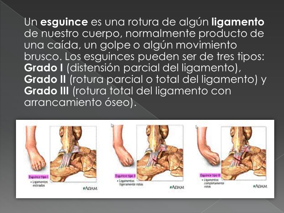 Un esguince es una rotura de algún ligamento de nuestro cuerpo, normalmente producto de una caída, un golpe o algún movimiento brusco.