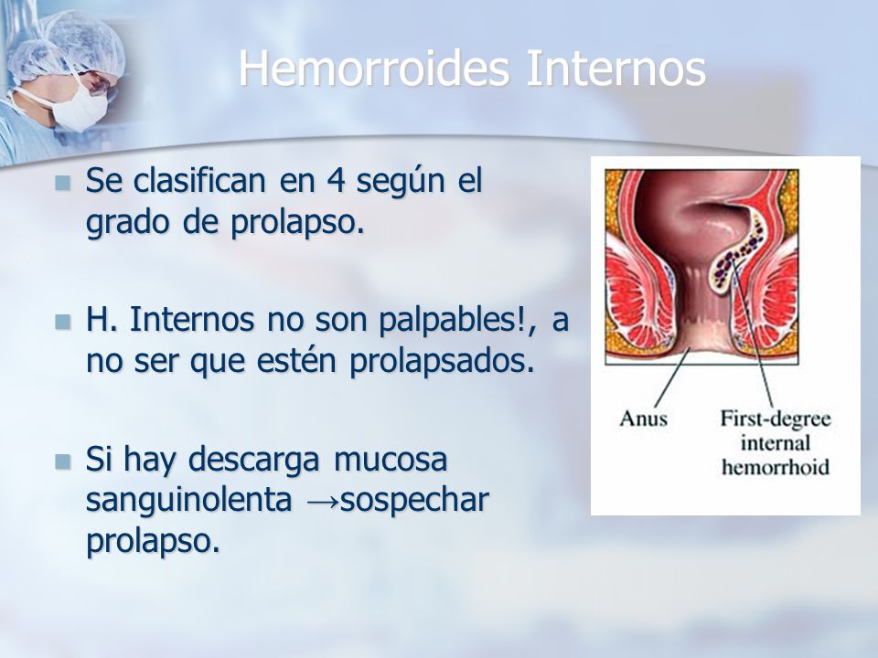 Hemorroides Internos Se clasifican en 4 según el grado de prolapso.