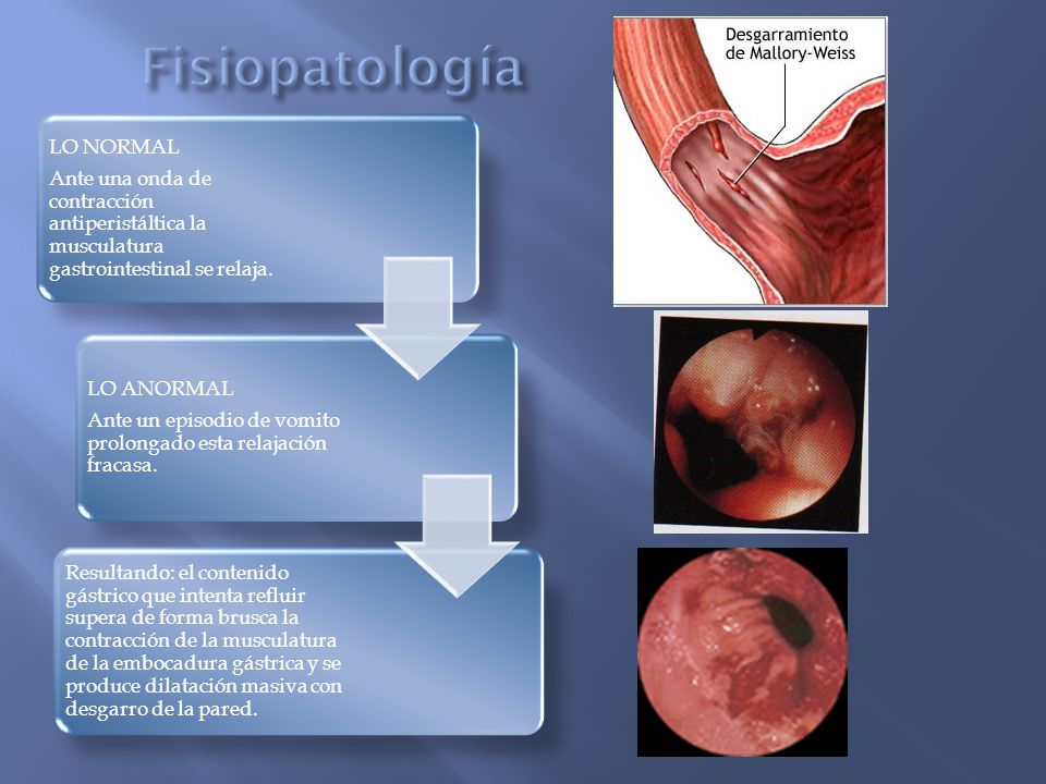 Fisiopatología Ante una onda de contracción antiperistáltica la musculatura gastrointestinal se relaja.