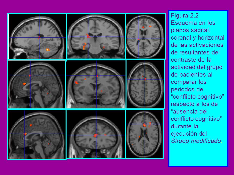 Figura 2.2 Esquema en los planos sagital, coronal y horizontal de las activaciones de resultantes del contraste de la actividad del grupo de pacientes al comparar los periodos de conflicto cognitivo respecto a los de ausencia del conflicto cognitivo durante la ejecución del Stroop modificado.