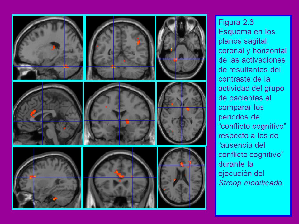 Figura 2.3 Esquema en los planos sagital, coronal y horizontal de las activaciones de resultantes del contraste de la actividad del grupo de pacientes al comparar los periodos de conflicto cognitivo respecto a los de ausencia del conflicto cognitivo durante la ejecución del Stroop modificado.