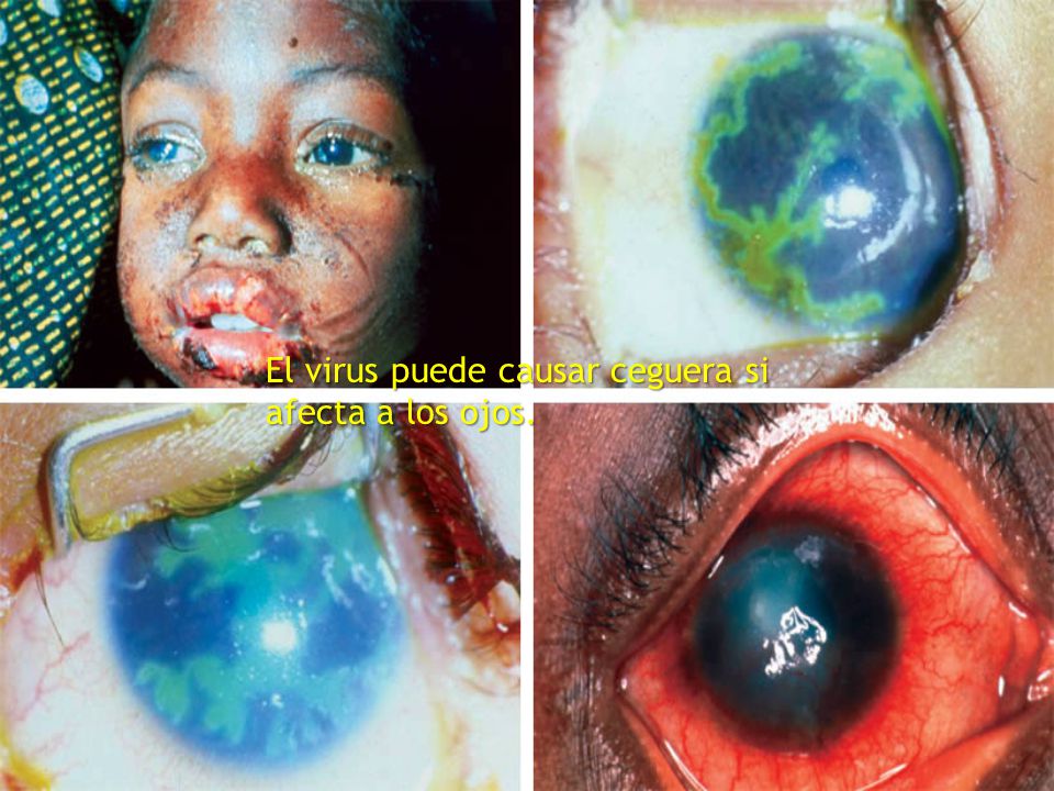 El virus puede causar ceguera si afecta a los ojos.