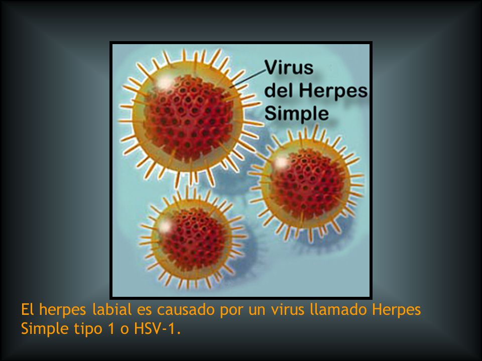 El herpes labial es causado por un virus llamado Herpes Simple tipo 1 o HSV-1.