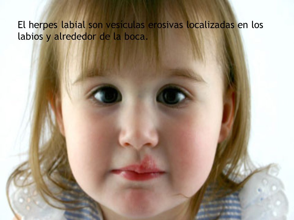 El herpes labial son vesículas erosivas localizadas en los labios y alrededor de la boca.