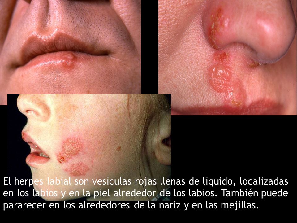 Herpes Labial Herpes mucocutáneo recurrente Dr. Pedro A. Ricart Reyes - ppt  video online descargar