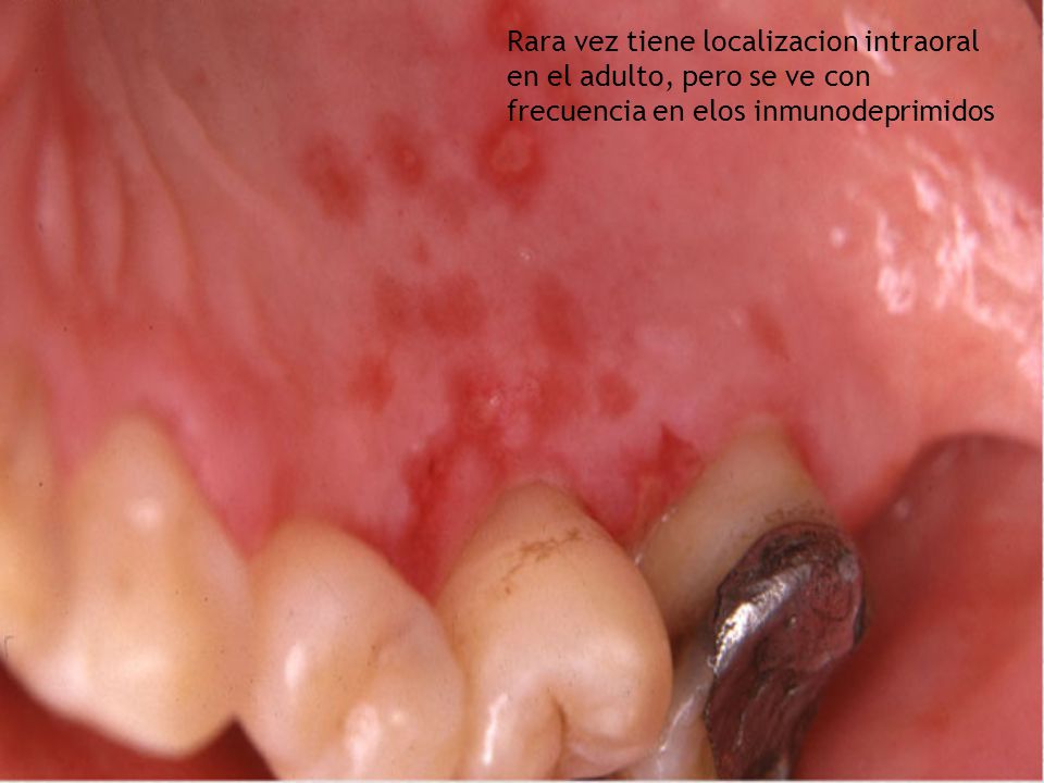 Rara vez tiene localizacion intraoral en el adulto, pero se ve con frecuencia en elos inmunodeprimidos