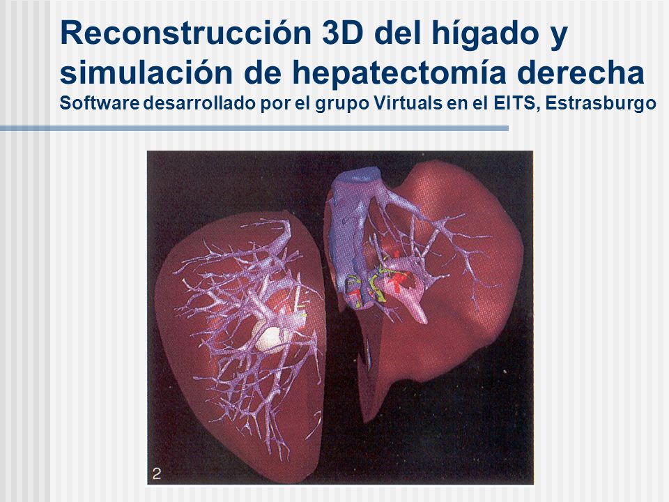 Reconstrucción 3D del hígado y simulación de hepatectomía derecha Software desarrollado por el grupo Virtuals en el EITS, Estrasburgo