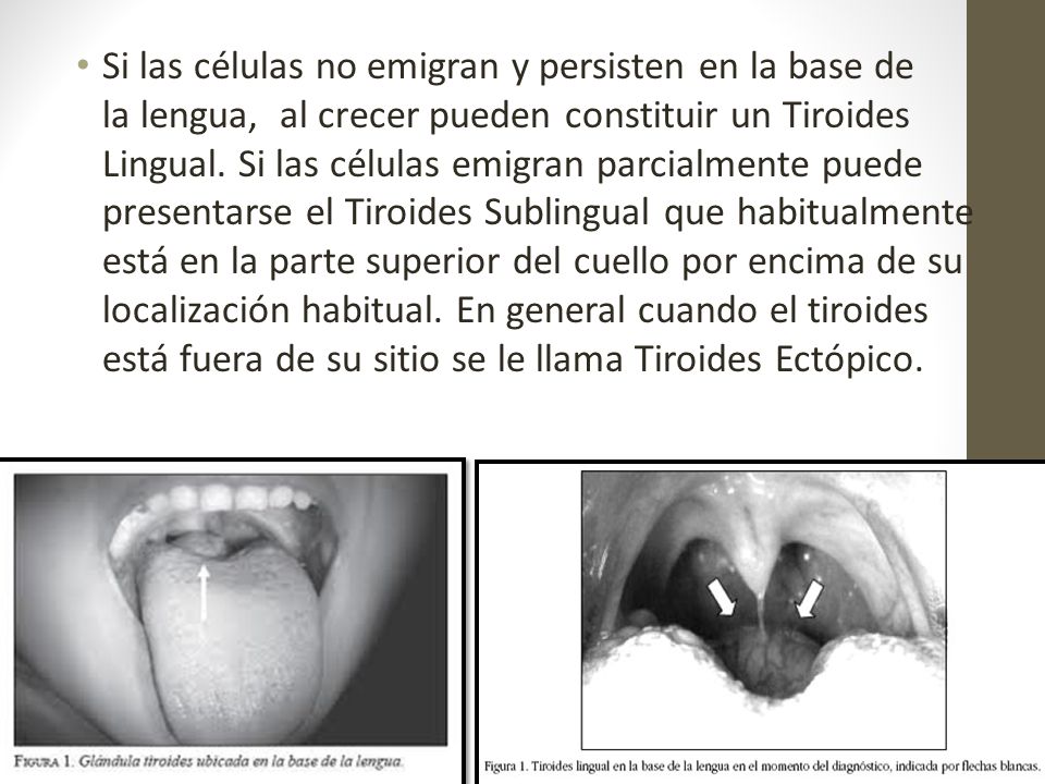 Si las células no emigran y persisten en la base de la lengua, al crecer pueden constituir un Tiroides Lingual.