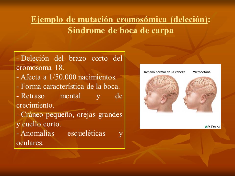 Ejemplo de mutación cromosómica (deleción): Síndrome de boca de carpa