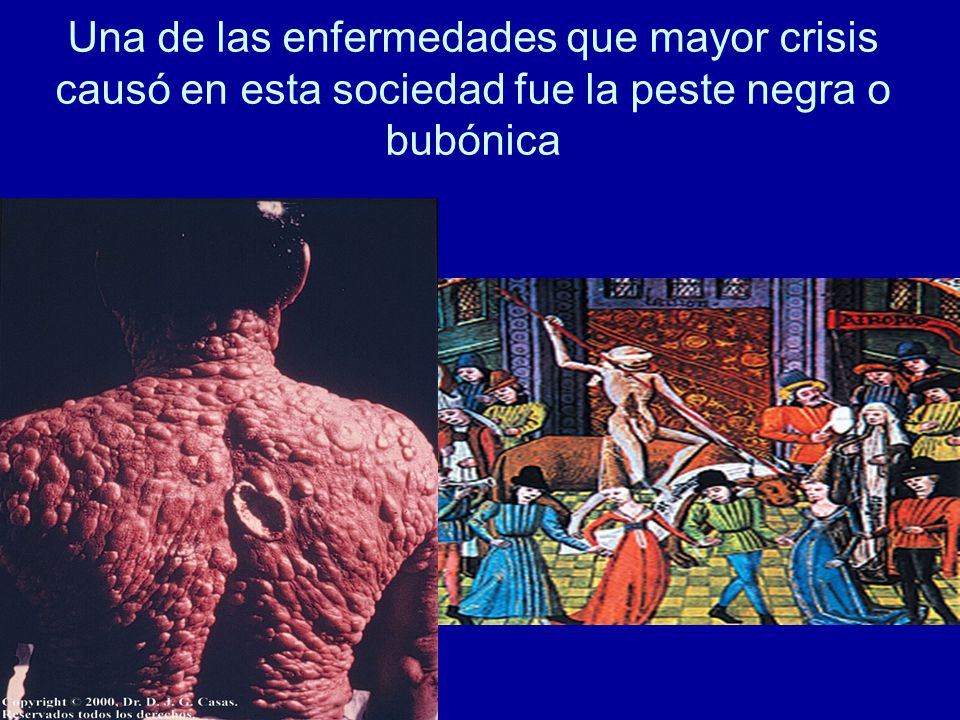 Una de las enfermedades que mayor crisis causó en esta sociedad fue la peste negra o bubónica