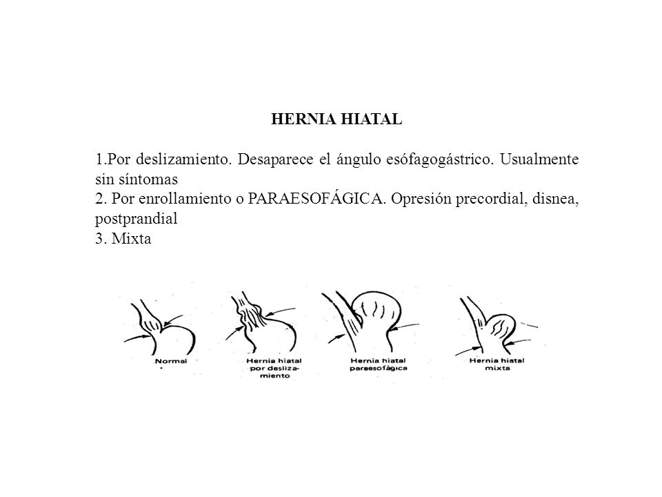 HERNIA HIATAL 1.Por deslizamiento. Desaparece el ángulo esófagogástrico. Usualmente sin síntomas.