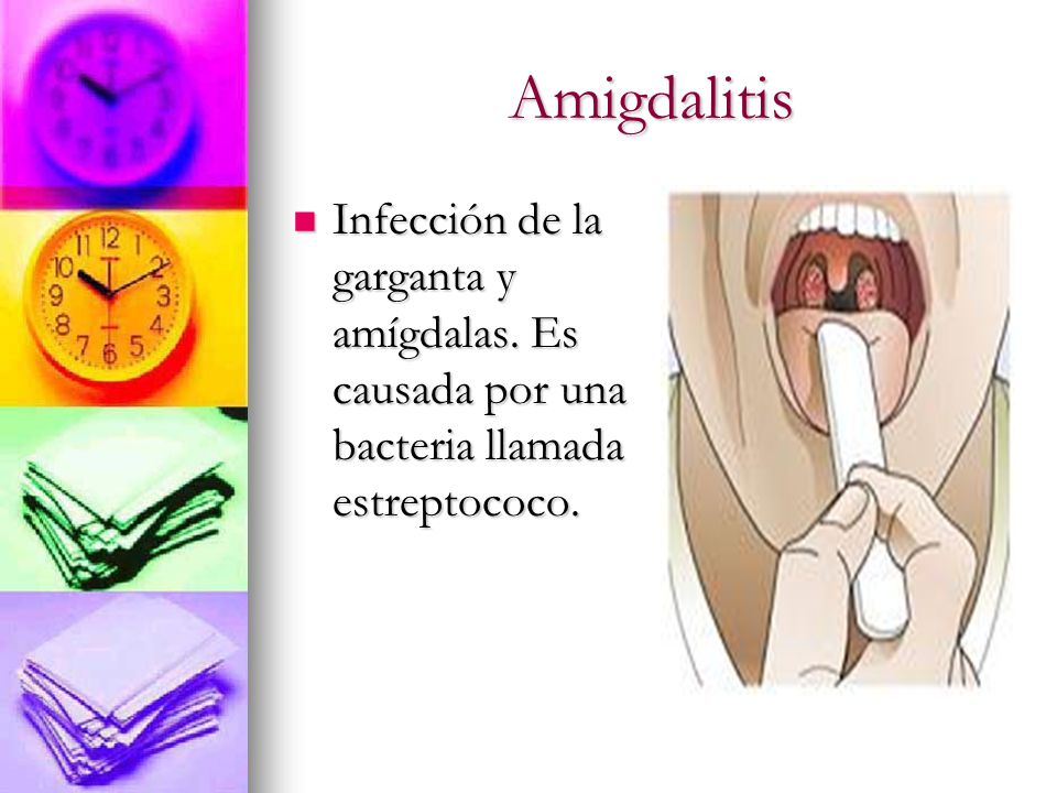 Amigdalitis Infección de la garganta y amígdalas. Es causada por una bacteria llamada estreptococo.