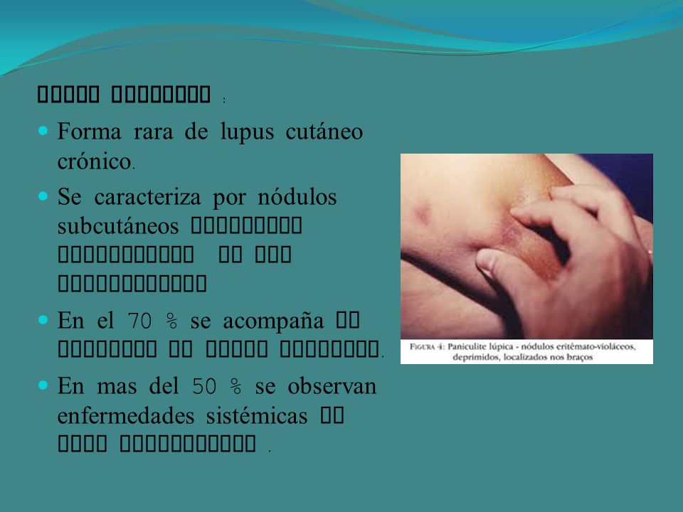Lupus profundo : Forma rara de lupus cutáneo crónico. Se caracteriza por nódulos subcutáneos indurados localizados en las extremidades.
