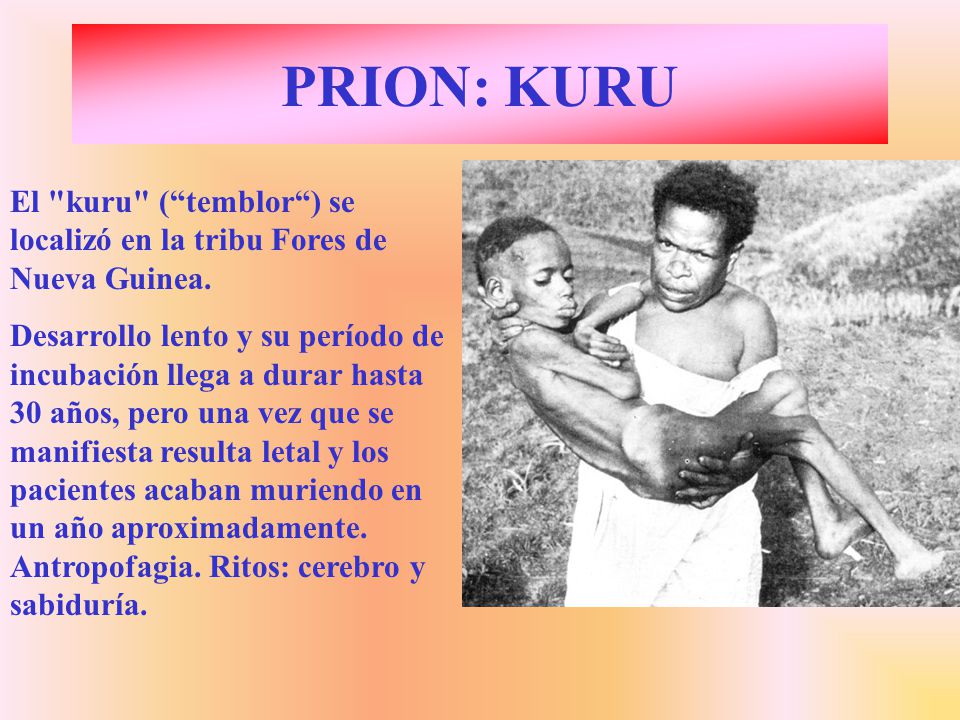 PRION: KURU El kuru ( temblor ) se localizó en la tribu Fores de Nueva Guinea.