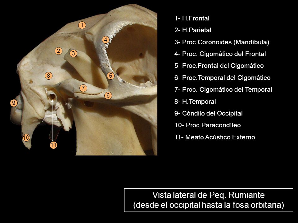 H.Frontal. 2- H.Parietal. 3- Proc Coronoides (Mandíbula)