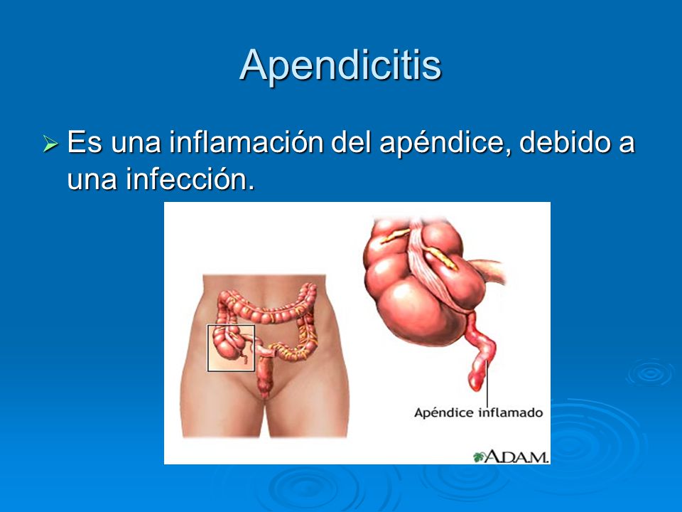 Apendicitis Es una inflamación del apéndice, debido a una infección.
