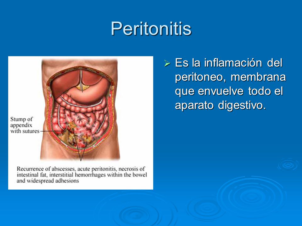 Peritonitis Es la inflamación del peritoneo, membrana que envuelve todo el aparato digestivo.