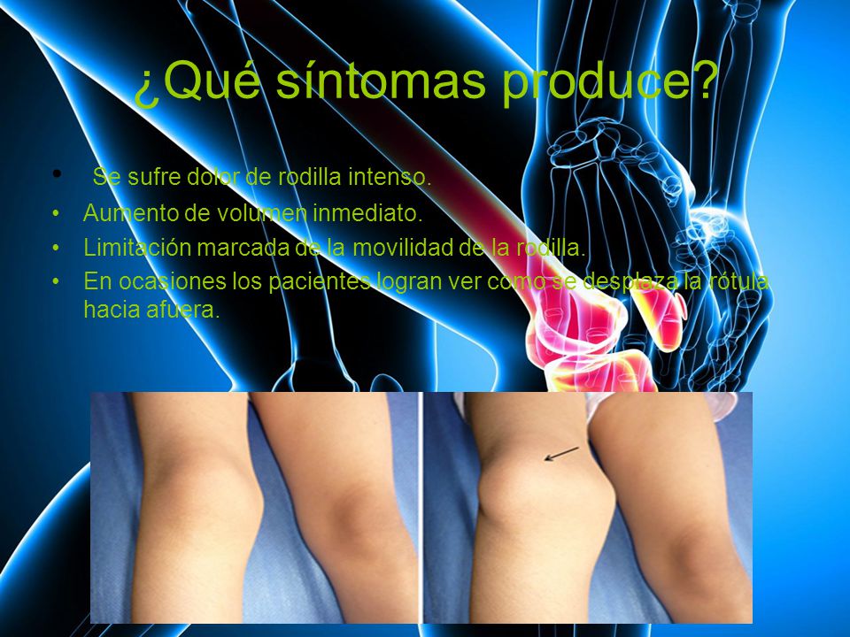 ¿Qué síntomas produce Se sufre dolor de rodilla intenso.