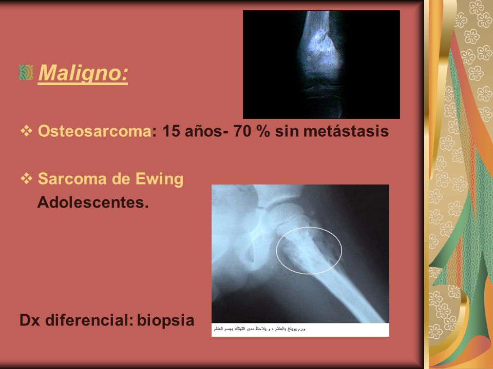 Maligno: Osteosarcoma: 15 años- 70 % sin metástasis Sarcoma de Ewing