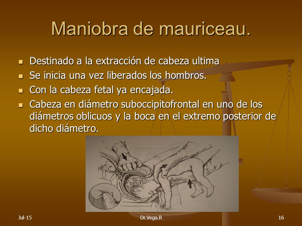 Maniobra de mauriceau. Destinado a la extracción de cabeza ultima