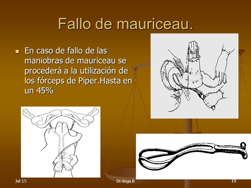 Fallo de mauriceau. En caso de fallo de las maniobras de mauriceau se procederá a la utilización de los fórceps de Piper.Hasta en un 45%
