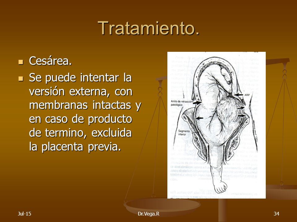 Tratamiento. Cesárea. Se puede intentar la versión externa, con membranas intactas y en caso de producto de termino, excluida la placenta previa.