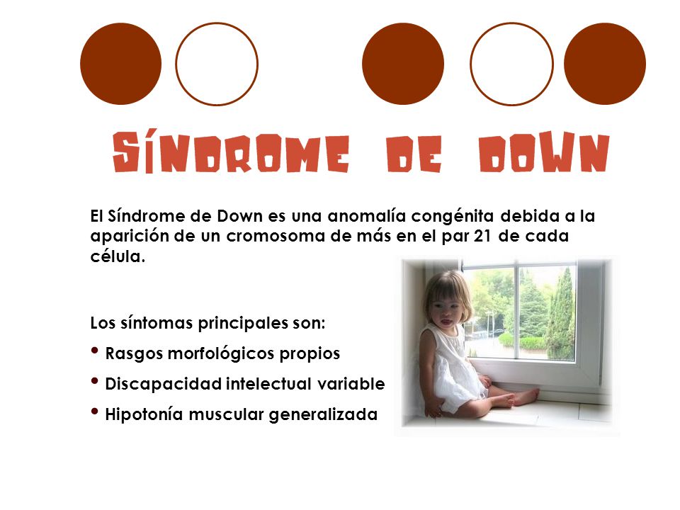 El Síndrome de Down es una anomalía congénita debida a la aparición de un cromosoma de más en el par 21 de cada célula.