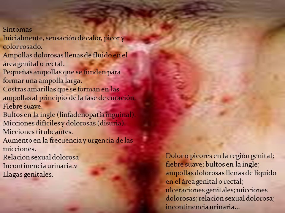 Síntomas Inicialmente, sensación de calor, picor y color rosado. Ampollas dolorosas llenas de fluido en el área genital o rectal.