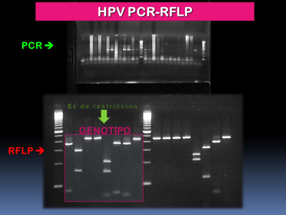 HPV PCR-RFLP PCR  Ez de restricción GENOTIPO RFLP 