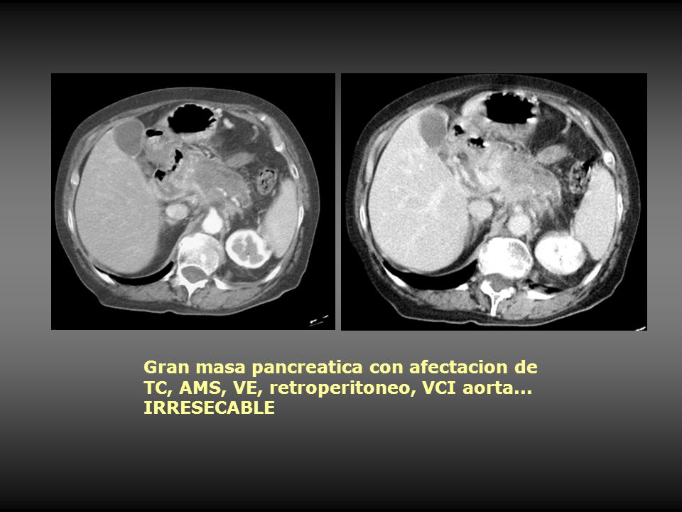 Gran masa pancreatica con afectacion de TC, AMS, VE, retroperitoneo, VCI aorta... IRRESECABLE