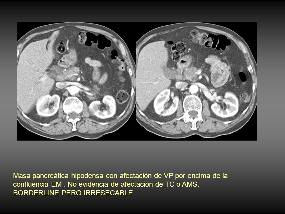 Masa pancreática hipodensa con afectación de VP por encima de la confluencia EM . No evidencia de afectación de TC o AMS.