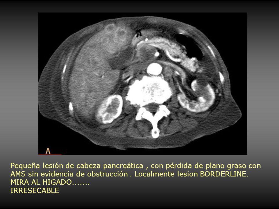 Pequeña lesión de cabeza pancreática , con pérdida de plano graso con AMS sin evidencia de obstrucción . Localmente lesion BORDERLINE.