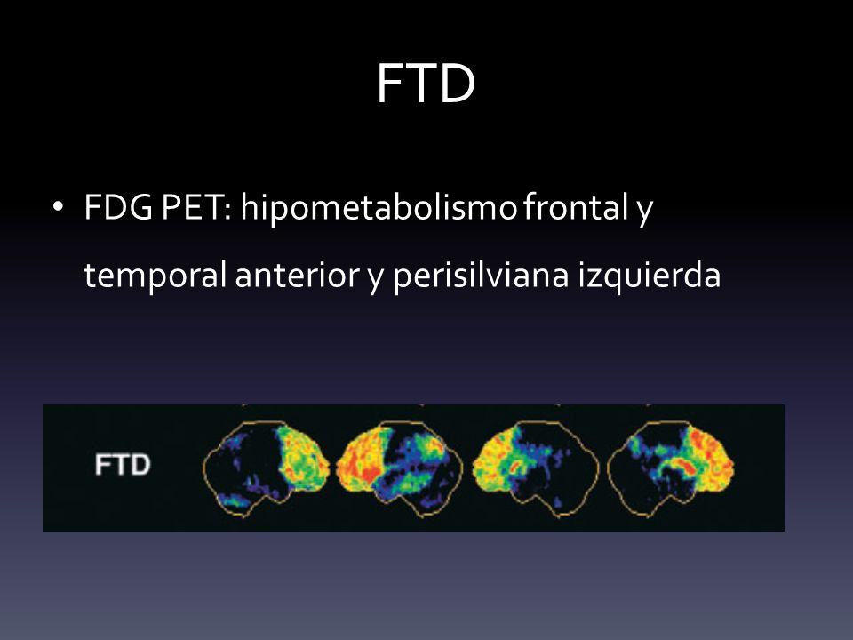FTD FDG PET: hipometabolismo frontal y temporal anterior y perisilviana izquierda