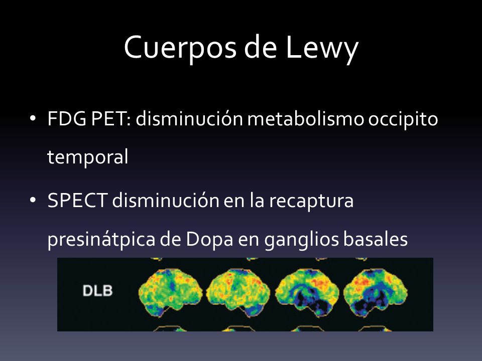 Cuerpos de Lewy FDG PET: disminución metabolismo occipito temporal