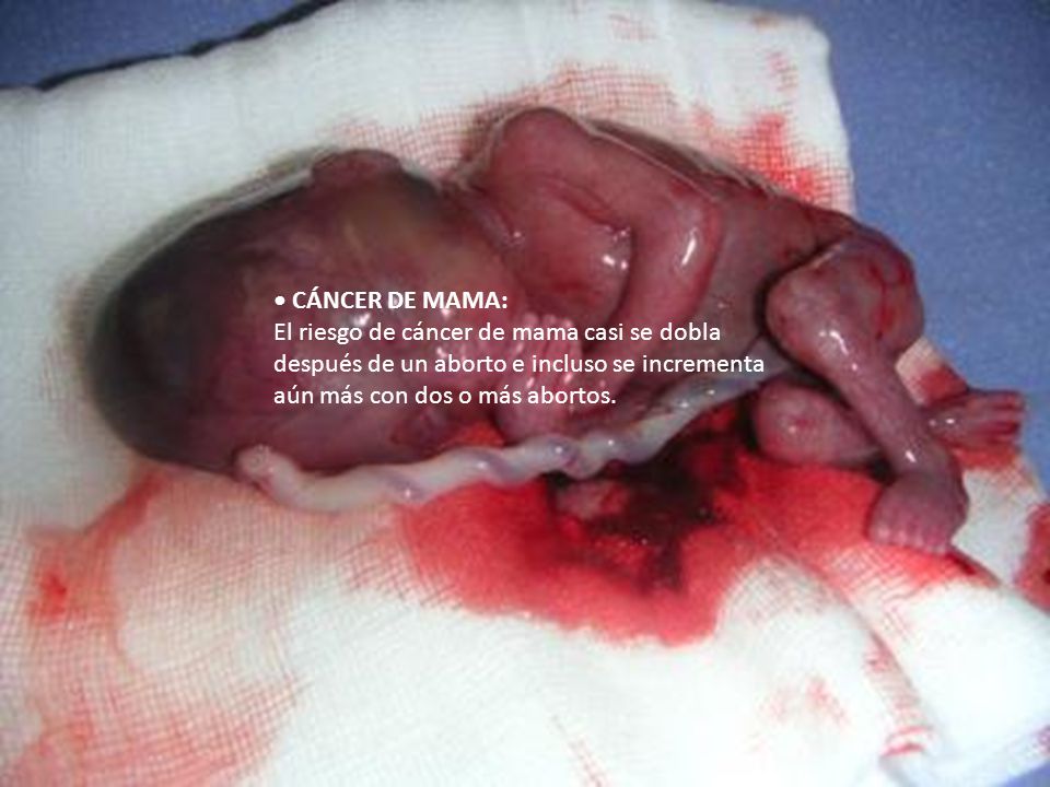 • CÁNCER DE MAMA: El riesgo de cáncer de mama casi se dobla después de un aborto e incluso se incrementa aún más con dos o más abortos.