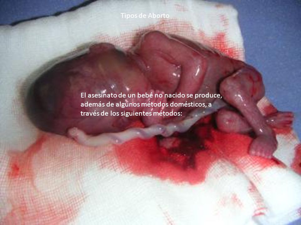 Tipos de Aborto El asesinato de un bebé no nacido se produce, además de algunos métodos domésticos, a través de los siguientes métodos: