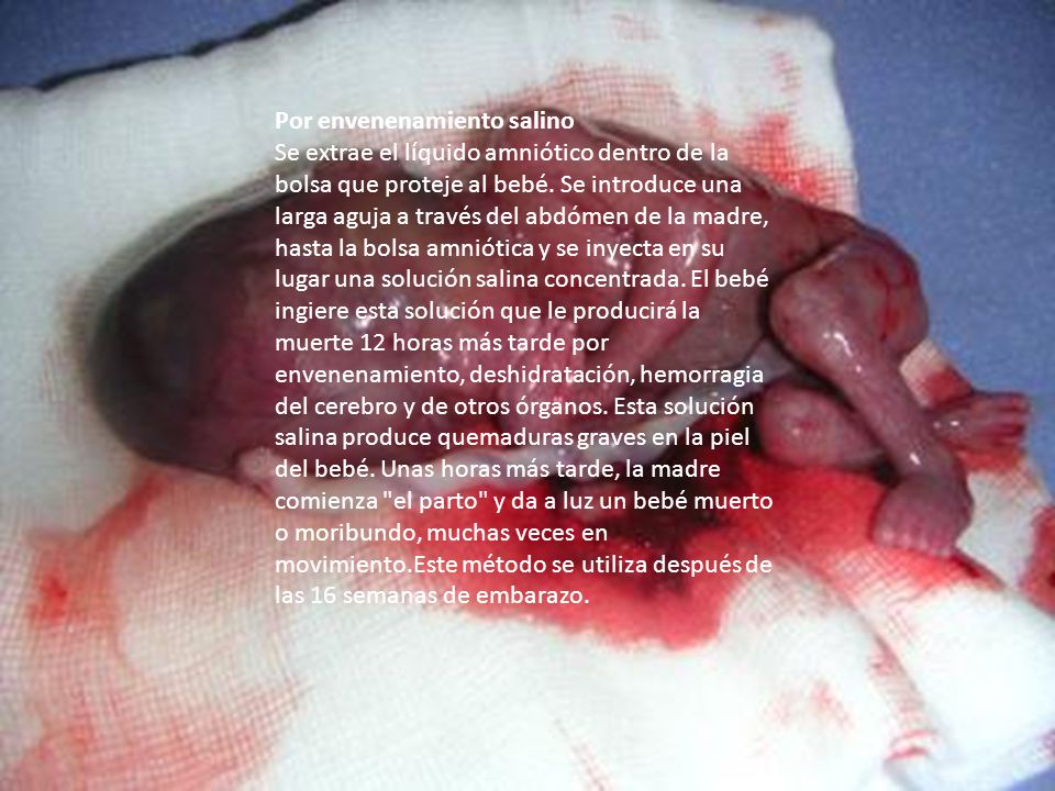 Por envenenamiento salino Se extrae el líquido amniótico dentro de la bolsa que proteje al bebé.