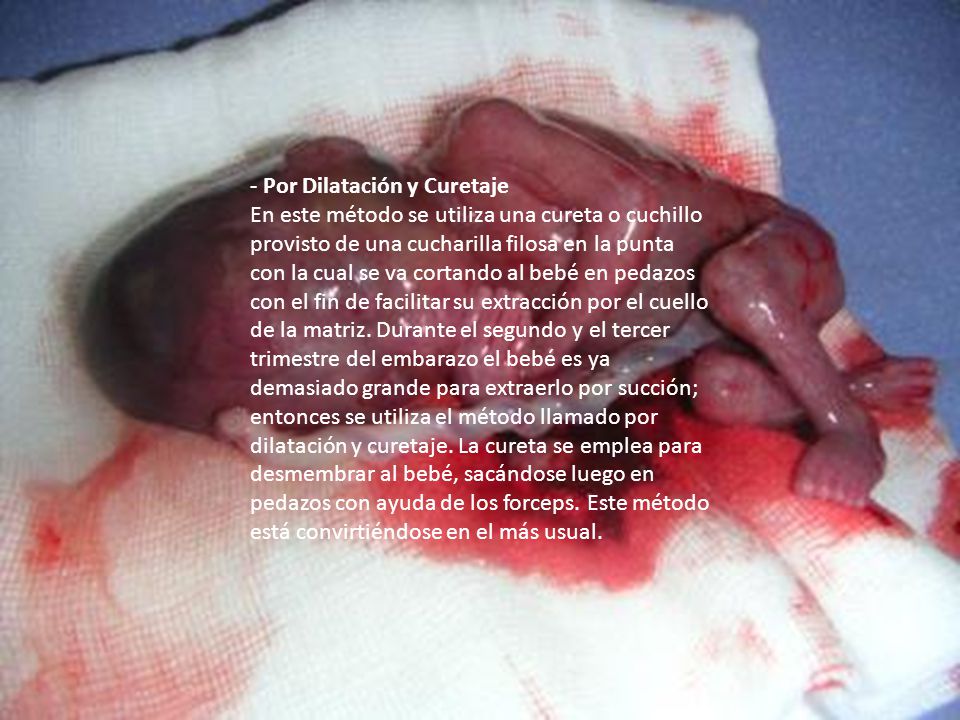 - Por Dilatación y Curetaje En este método se utiliza una cureta o cuchillo provisto de una cucharilla filosa en la punta con la cual se va cortando al bebé en pedazos con el fin de facilitar su extracción por el cuello de la matriz.